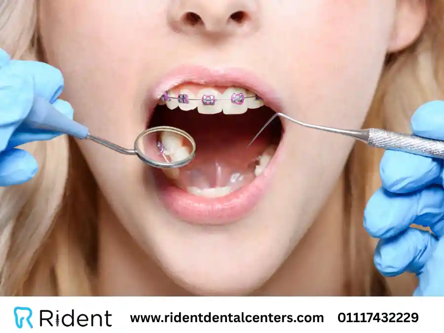 مركز تقويم الاسنان الأفضل في مصر و6 نصائح هامة